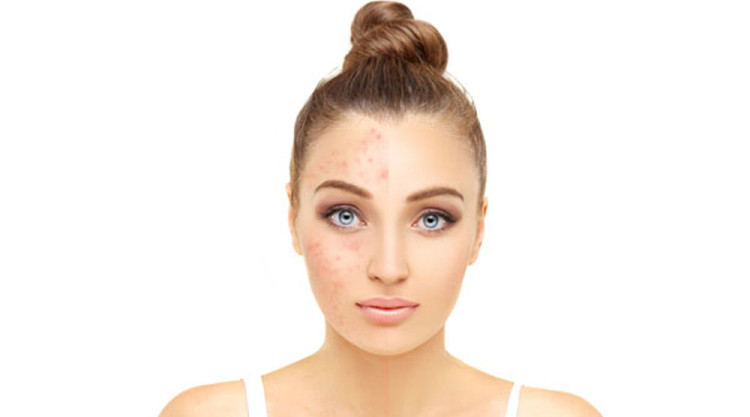 Comment lutter contre la peau grasse - Parfumonsnous